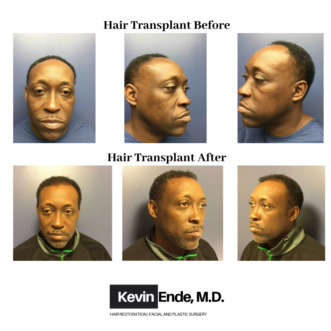 hair transplant