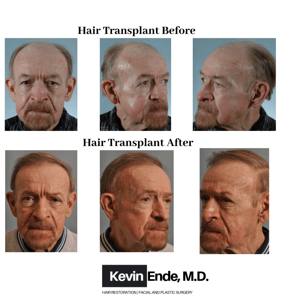 hair transplant examples