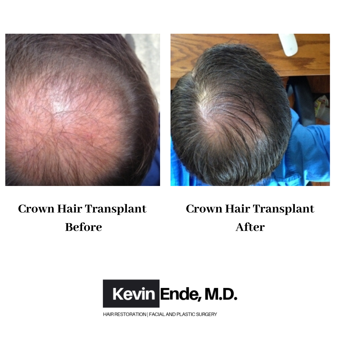 hair transplant