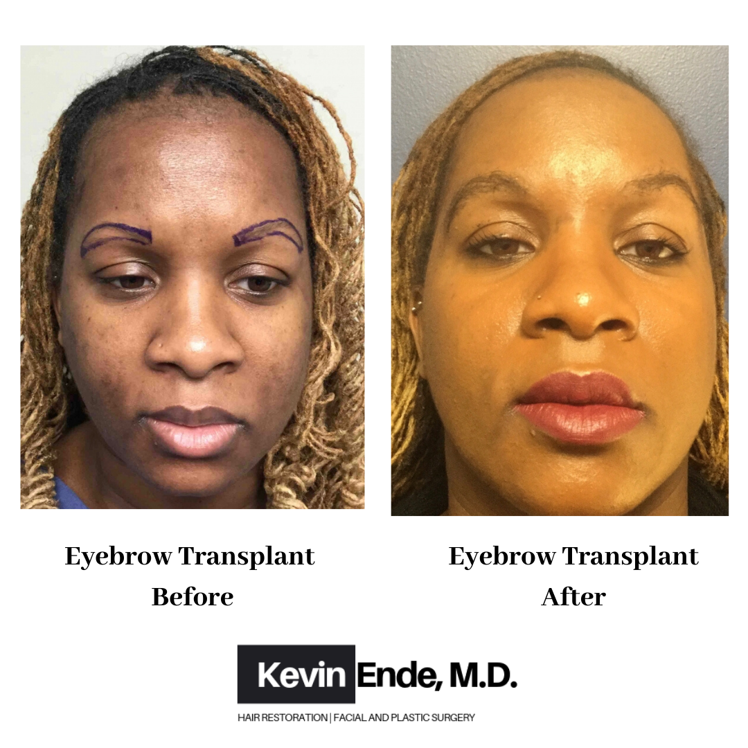 hair transplant
