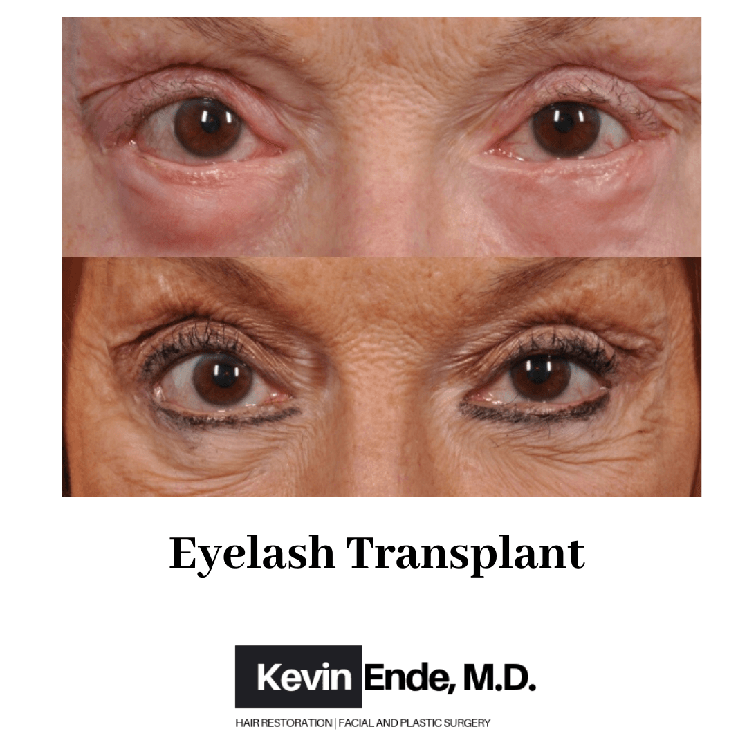 hair transplant