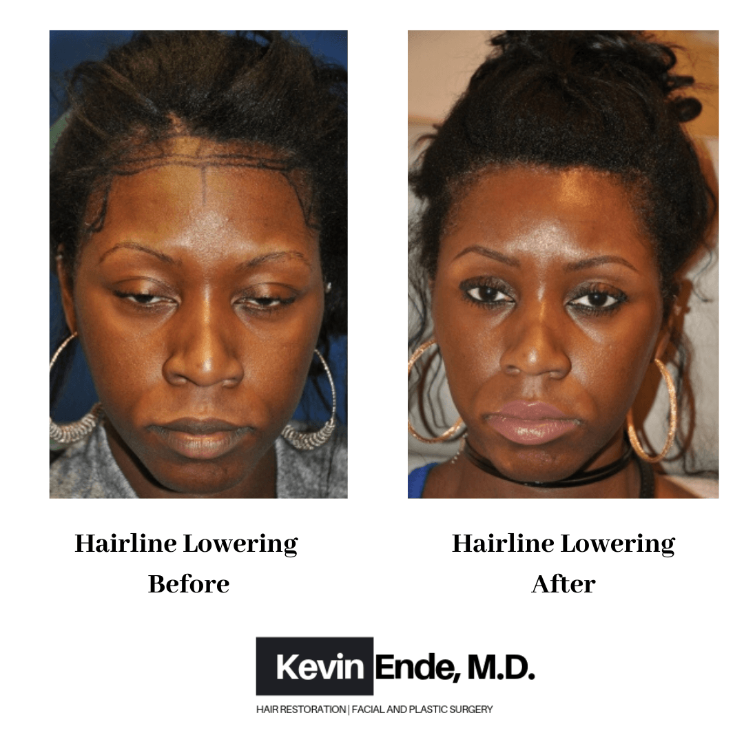 hair transplant