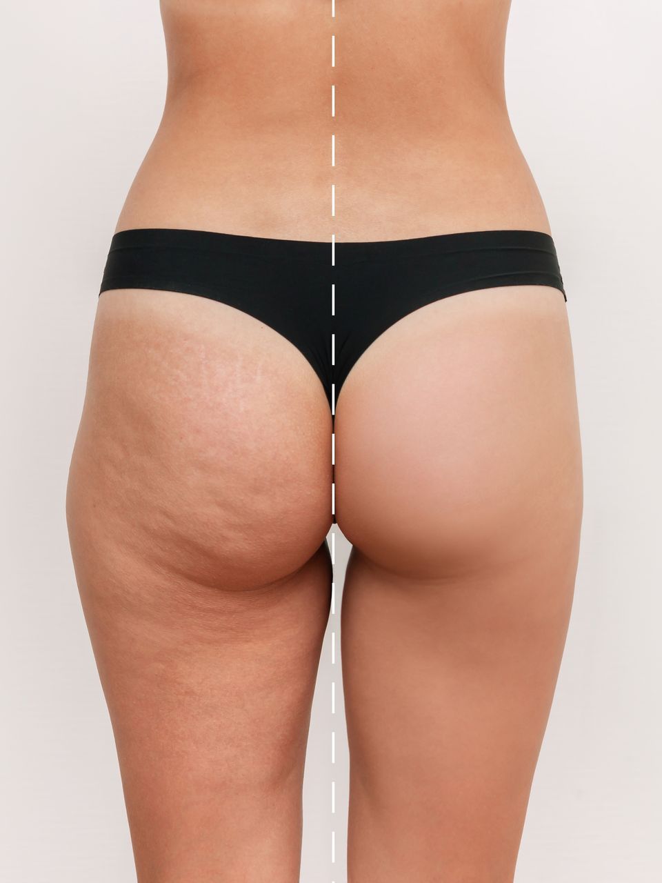 Cellulite Removal Treatment