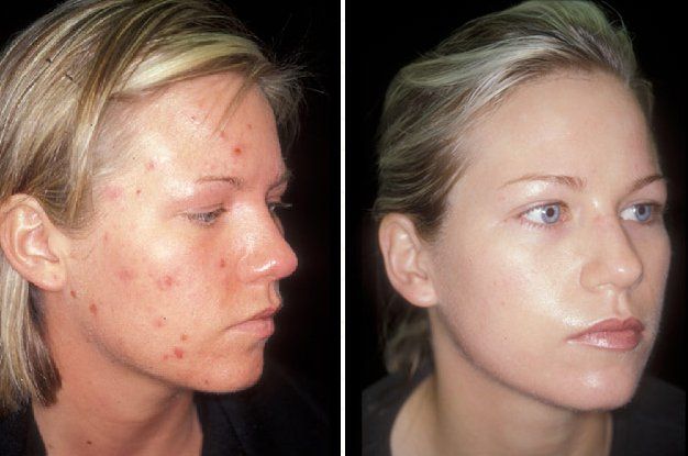 accutane online shop