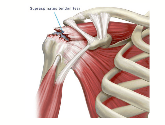 Anatomic description of degenerative rotator cuff tear. The common site