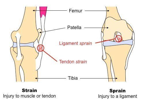 Whats The Difference Between A Strain And A Sprain Unraveling The Mystery 0474