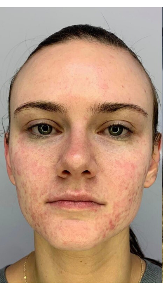 A person facing forward showing visible redness, texture, and acne-like breakouts across their cheeks and chin.