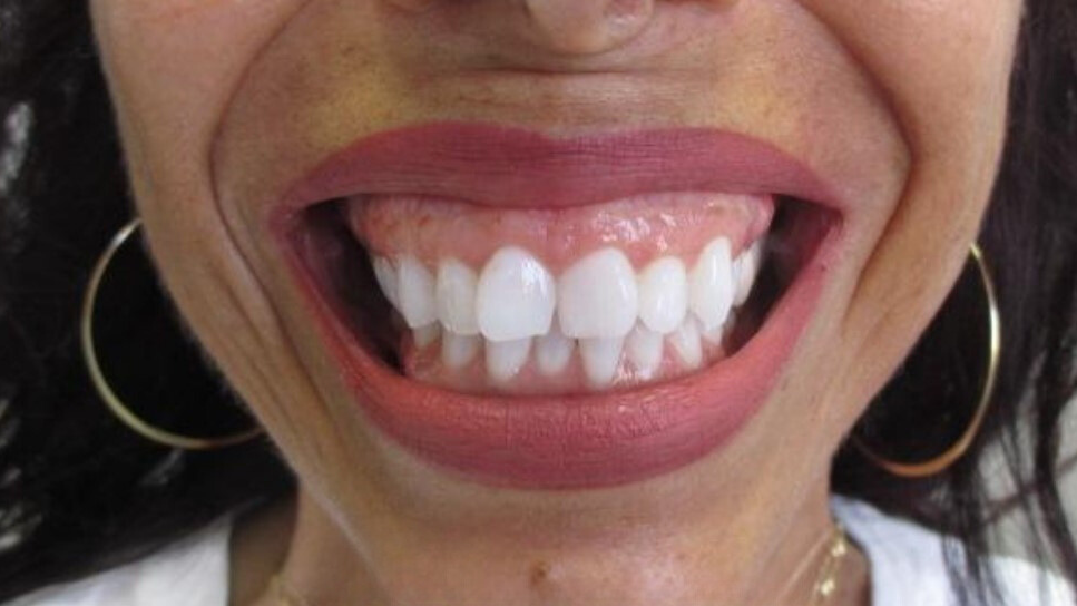 A close-up of a person's mouth with a wide smile, showing white teeth and healthy pink gums.