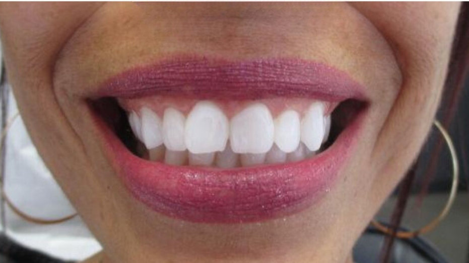 A close-up of a person smiling, revealing bright white, well-aligned teeth and healthy gums.