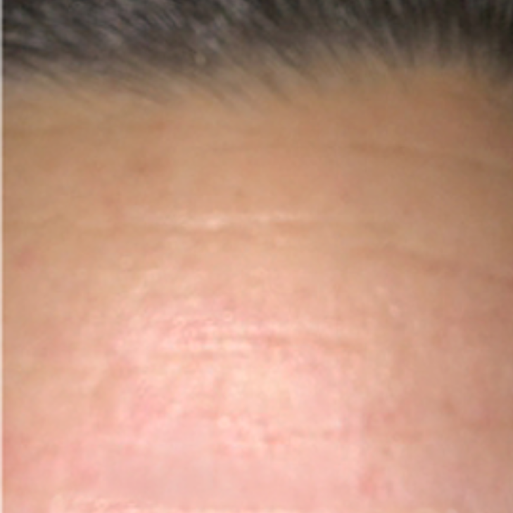 Close-up of human forehead skin showing natural texture, faint horizontal lines, and hairline at the top.