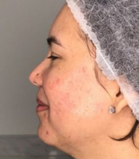 A profile view of a person wearing a disposable hair cap, showing skin texture and acne on the cheek and jawline.