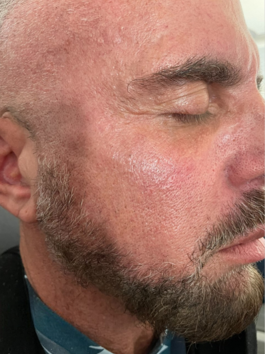 Close-up of a person's side profile, showing skin with a reddish, scaly texture on the cheek and temple area.