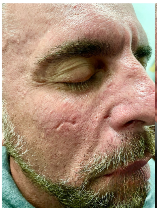 A close-up of a person's cheek showing recessed acne scarring and visible skin texture.
