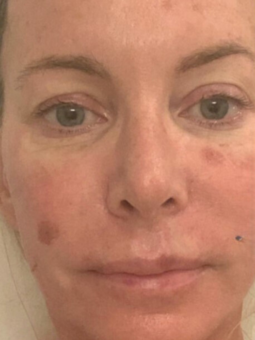 Close-up of a face showing various pigmented skin spots on the cheeks and forehead.