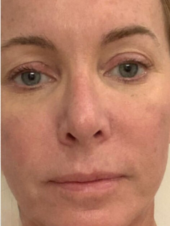 Close-up of a person’s face, highlighting redness and slight swelling along both upper eyelids.
