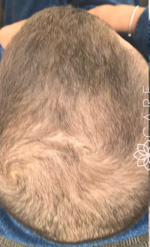 Top-down view of a person's scalp showing thinning hair around the crown and a visible hair whorl.