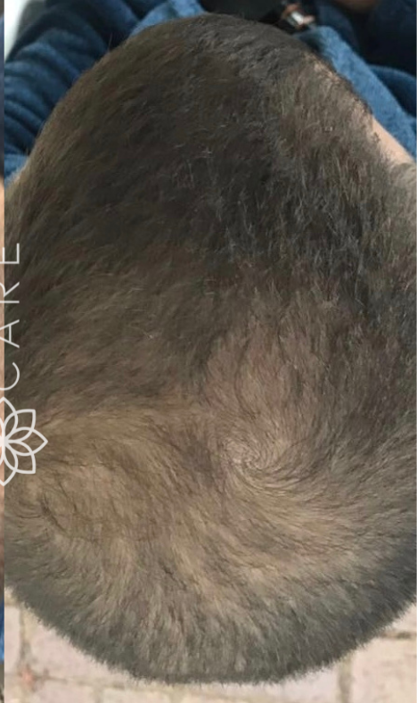 A close-up view of the back of a person's head, showing short, dark hair with a visible crown swirl.