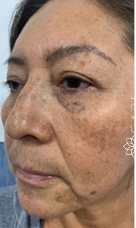 Close-up of a face showing various areas of hyperpigmentation and sun spots on the cheek, nose, and under-eye area.