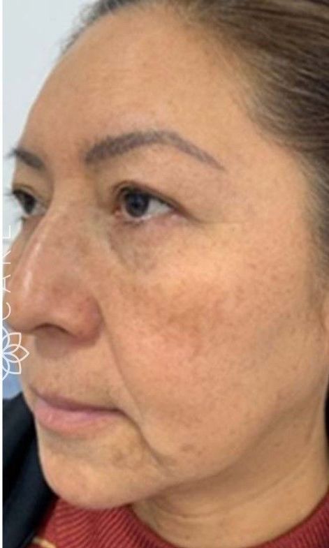 A close-up profile of a face showing hyperpigmentation and skin texture changes on the cheek and under-eye area.