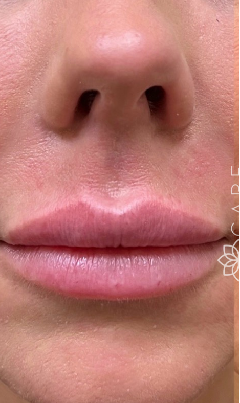 A close-up view of a person's mouth and nose, showcasing hydrated, smooth lips.