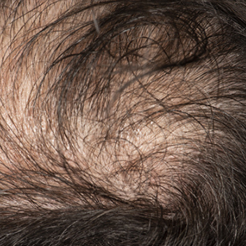 Close-up view of thinning dark hair on a human scalp, showing visible skin and texture.