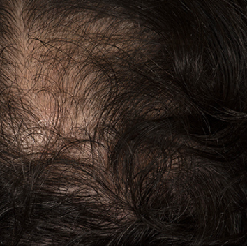 A close-up view of dark hair on a scalp showing noticeable thinning and exposed skin.