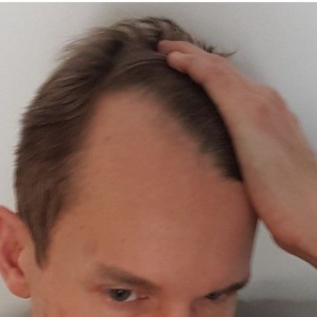 A person holds their hair back, revealing a receding hairline and thinning hair at the temples.