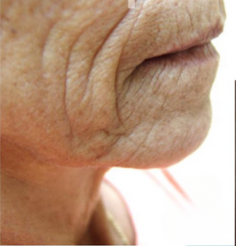 Close-up of a face showing prominent marionette lines and skin texture around the mouth and chin.