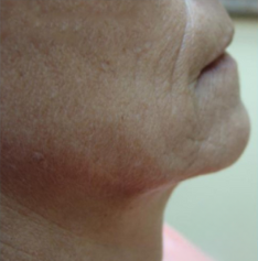 A close-up profile view of a jawline and lower face showing skin texture, facial creases, and the chin area.