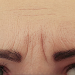 A close-up view of a person's forehead, showing visible vertical frown lines between the eyebrows.