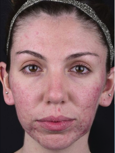 A close-up portrait showing persistent facial redness, uneven skin texture, and visible breakouts across the cheeks and chin.