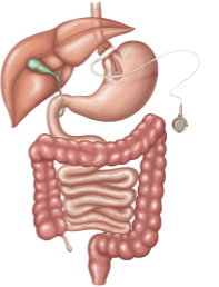 Diagram of a digestive system with a gastric band, including the liver, stomach, and intestines.