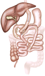 Illustration of a Roux-en-Y gastric bypass surgery; liver, gallbladder, and rerouted digestive tract are depicted.