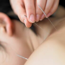 Acupuncture - Therapy in Millis, MA