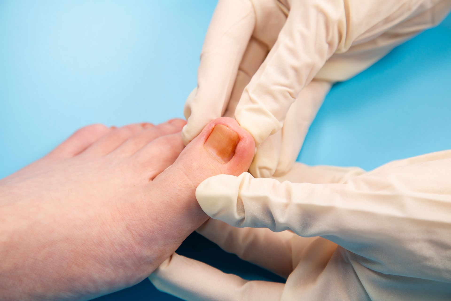 Foot with discolored toenail being examined by gloved hands against a blue background.