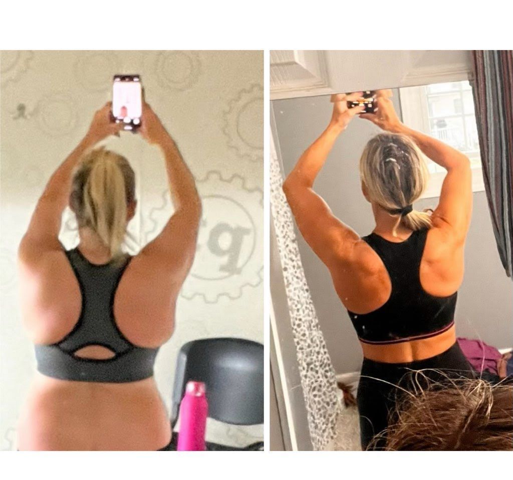 Woman showing medical weight loss treatment results in Springfield, MA