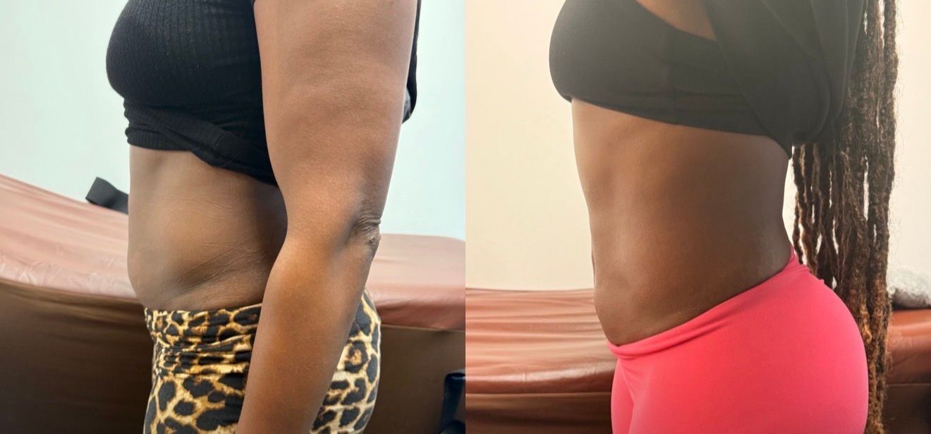 Side-by-side view of a person before and after a body contouring procedure. Shows stomach area and tight clothing.