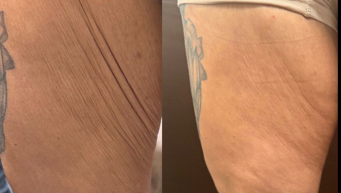example of body sculpting results to tighten skin