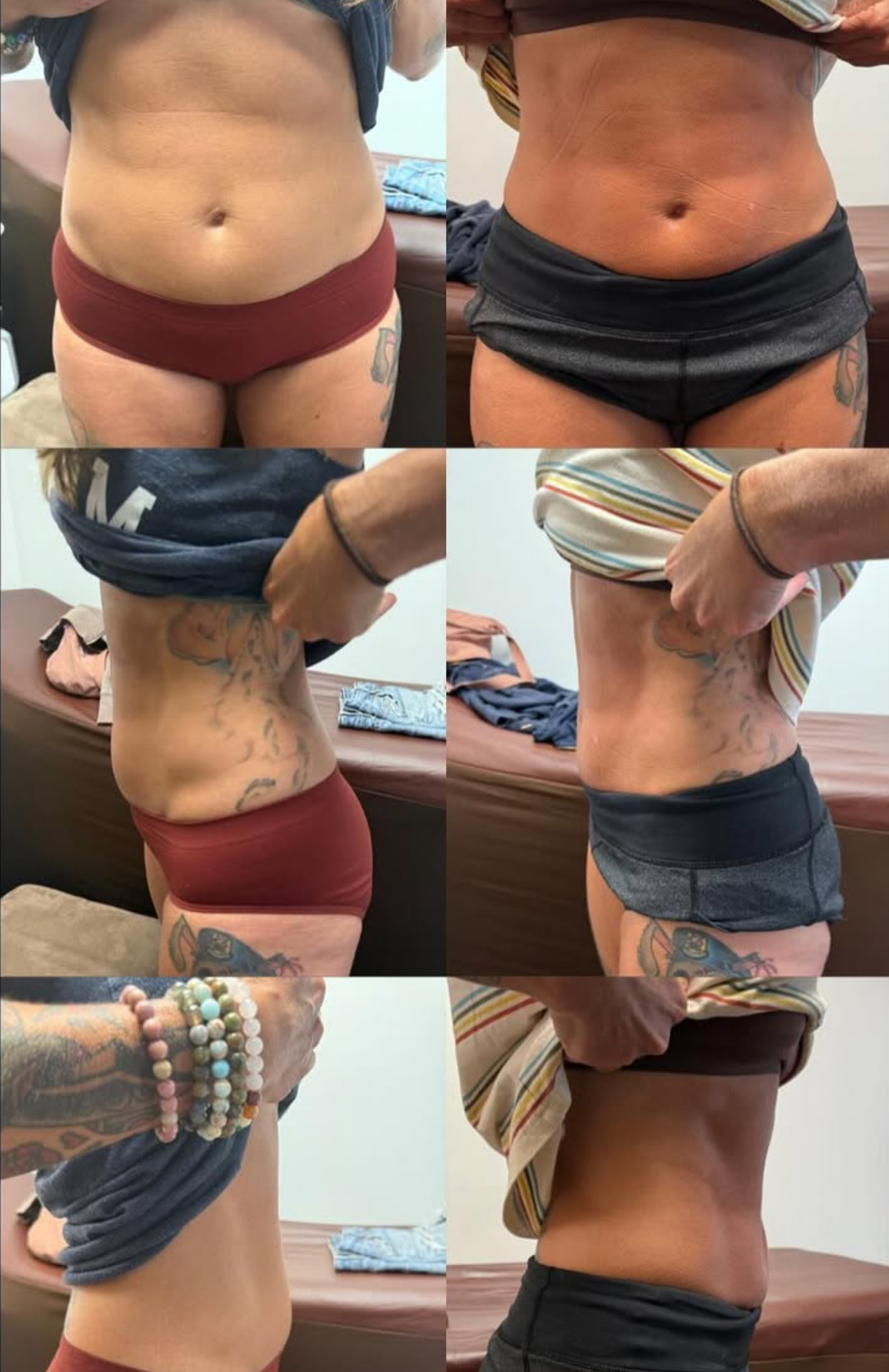 Results from Lipo Laser body sculpting treatments in Springfield, MA