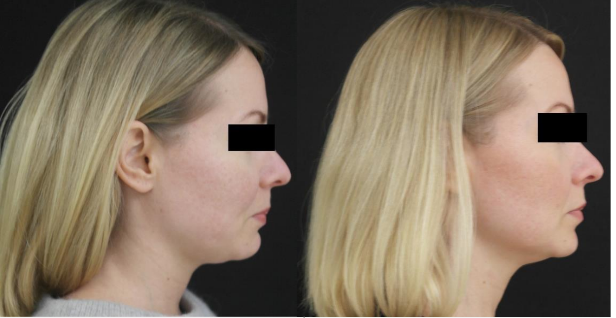 HIFU Works for Double Chin Reduction