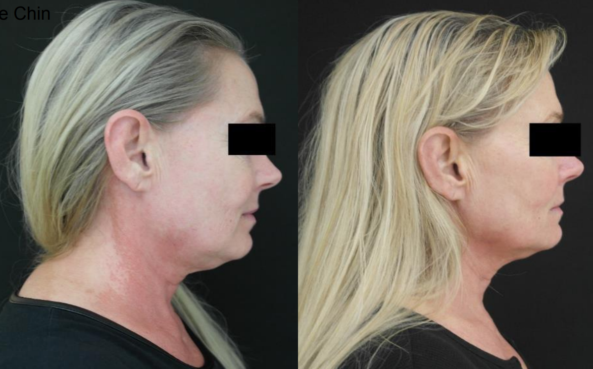 Double Chin Reduction
