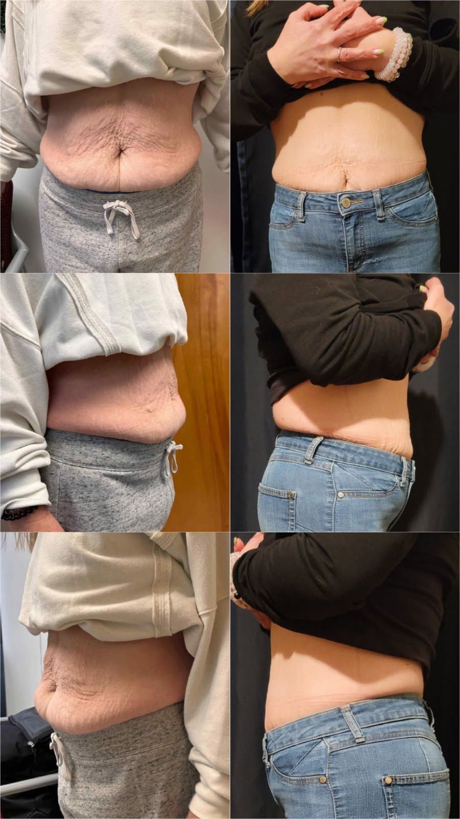 A collage of four pictures of a woman 's stomach before and after weight loss.
