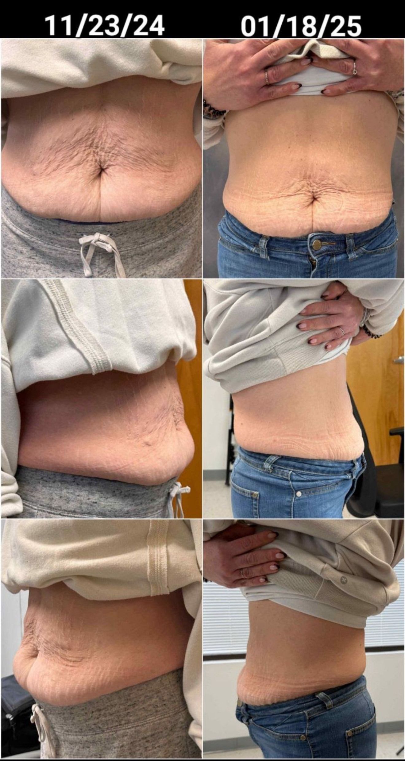 A woman 's stomach is shown in a collage of four photos - medical weight loss