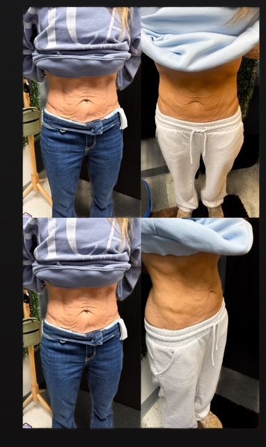 A before and after picture of a woman 's stomach