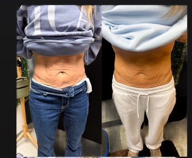 A before and after picture of a woman 's stomach