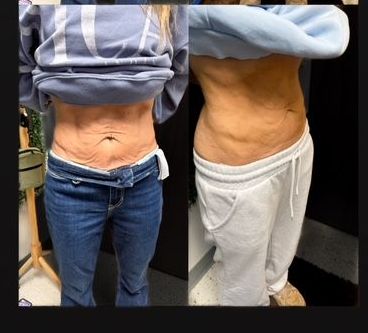 A before and after picture of a woman 's stomach