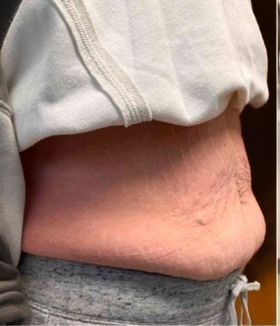 A woman 's stomach is shown in a collage of three photos.