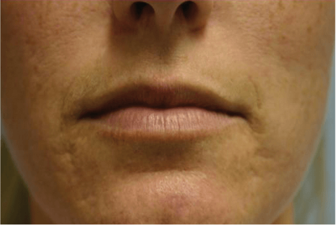 Before and after results of laser skin treatment on the mouth area
