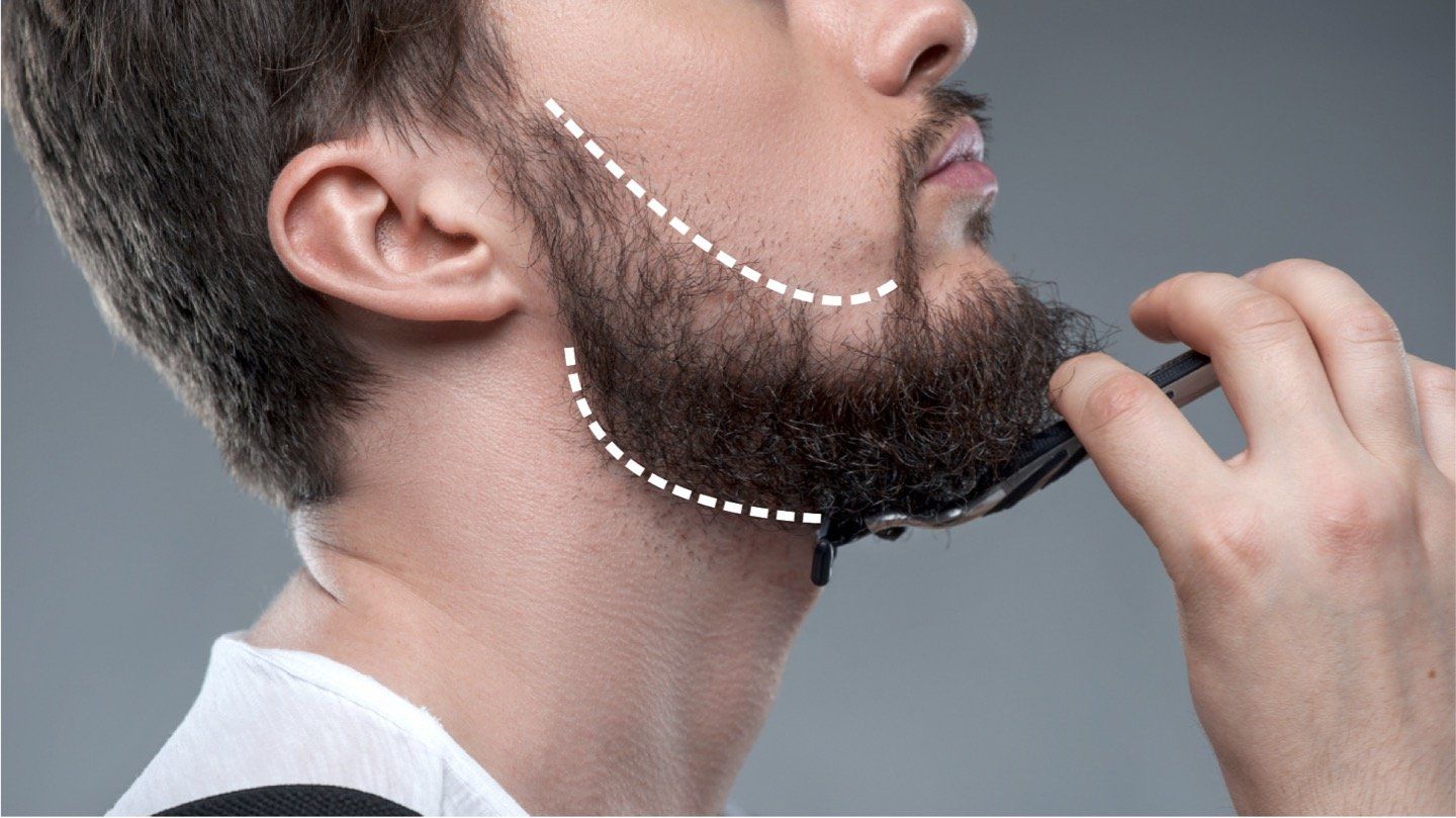 Beard line for laser hair removal