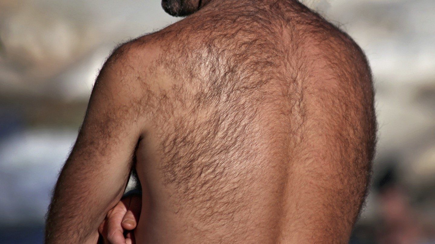 Mens back hair laser hair removal